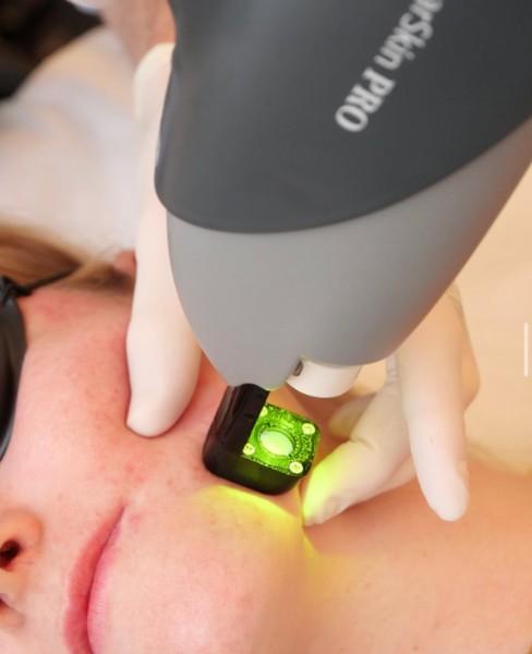 Le laser vasculaire : une solution efficace et définitive pour vos rougeurs