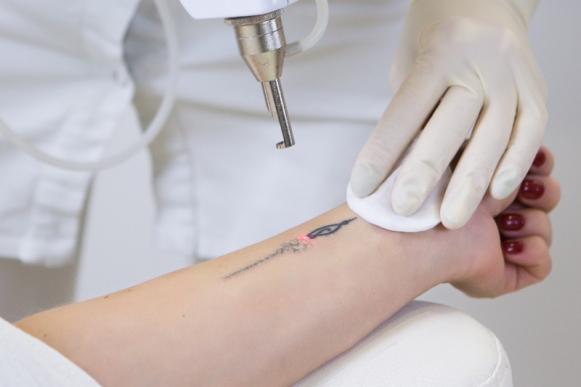 laser pour enlever tatouage