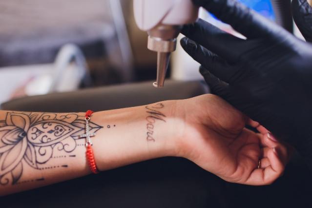 laser tatouage