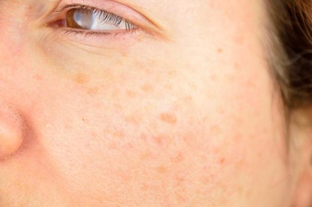 Laser contre les taches : quand et comment intervenir ?